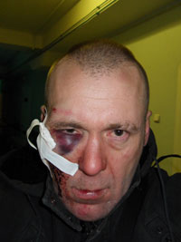 В.Ефимов после операции